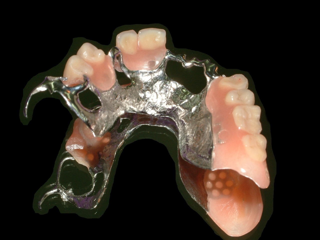 部分入れ歯　チタン床